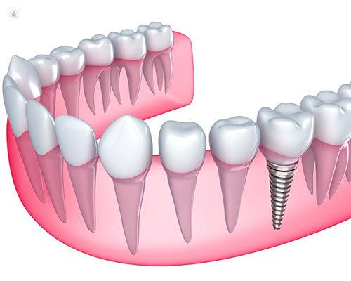 Modelo implantes dentales
