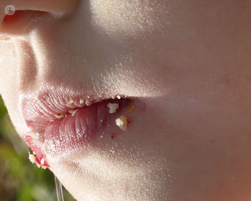 Persona con heridas en los labios - ´úlceras bucales - by Top Doctors