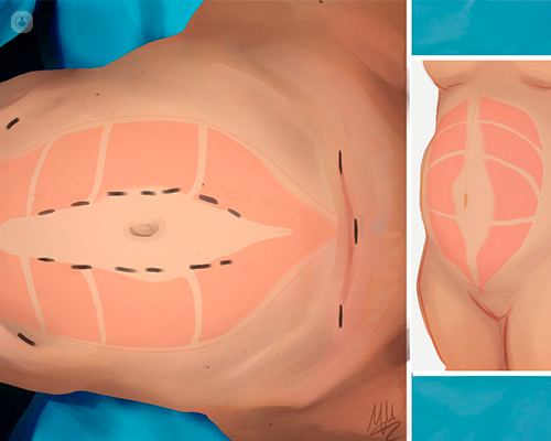 REPA, la cirugía endoscópica para la diástasis abdominal | TOP DOCTORS