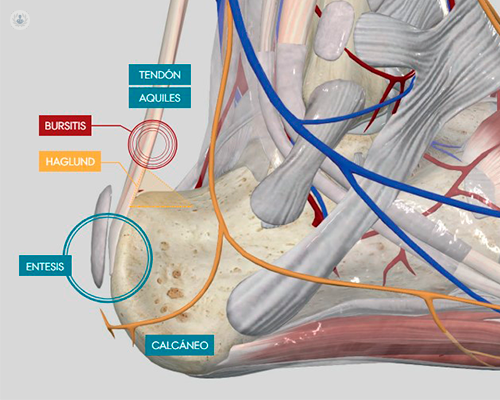 tendon-de-aquiles