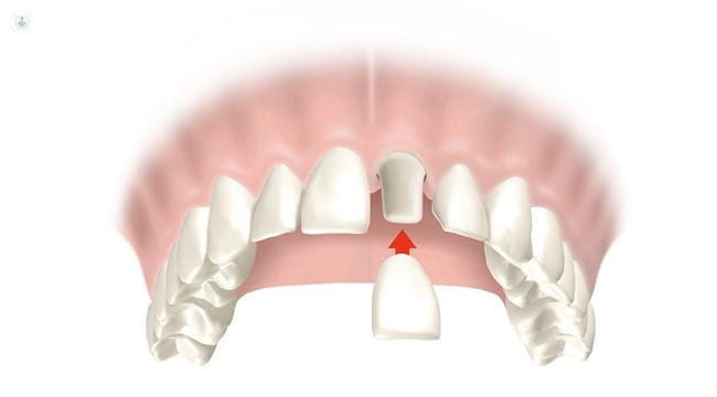 Cuánto dura una corona dental? | Top Doctors