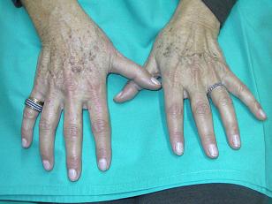 Eliminar manchas y lesiones pigmentadas cutáneas con láser|Top Doctors